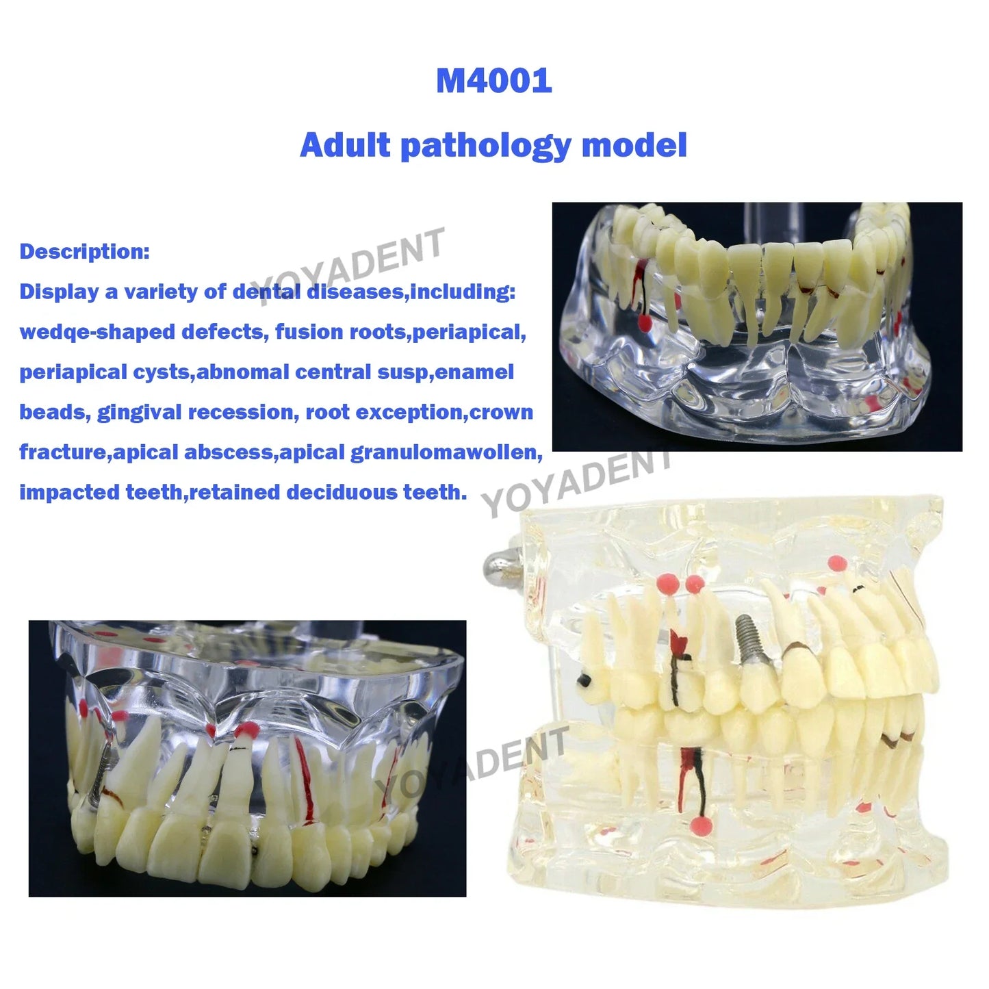 Dental Teeth Teaching Model Set – Typodont Orthodontic Practice Model for Dental Education, Study & Demonstration