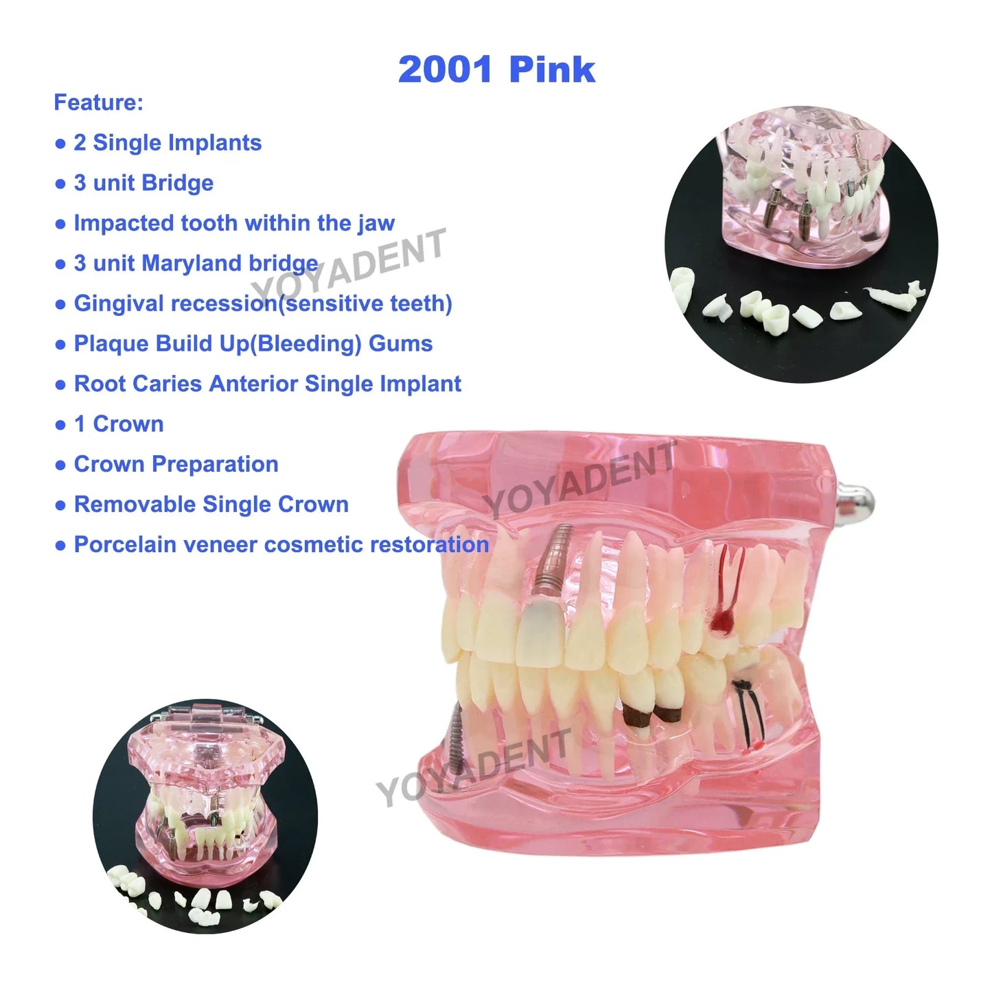 Dental Teeth Teaching Model Set – Typodont Orthodontic Practice Model for Dental Education, Study & Demonstration