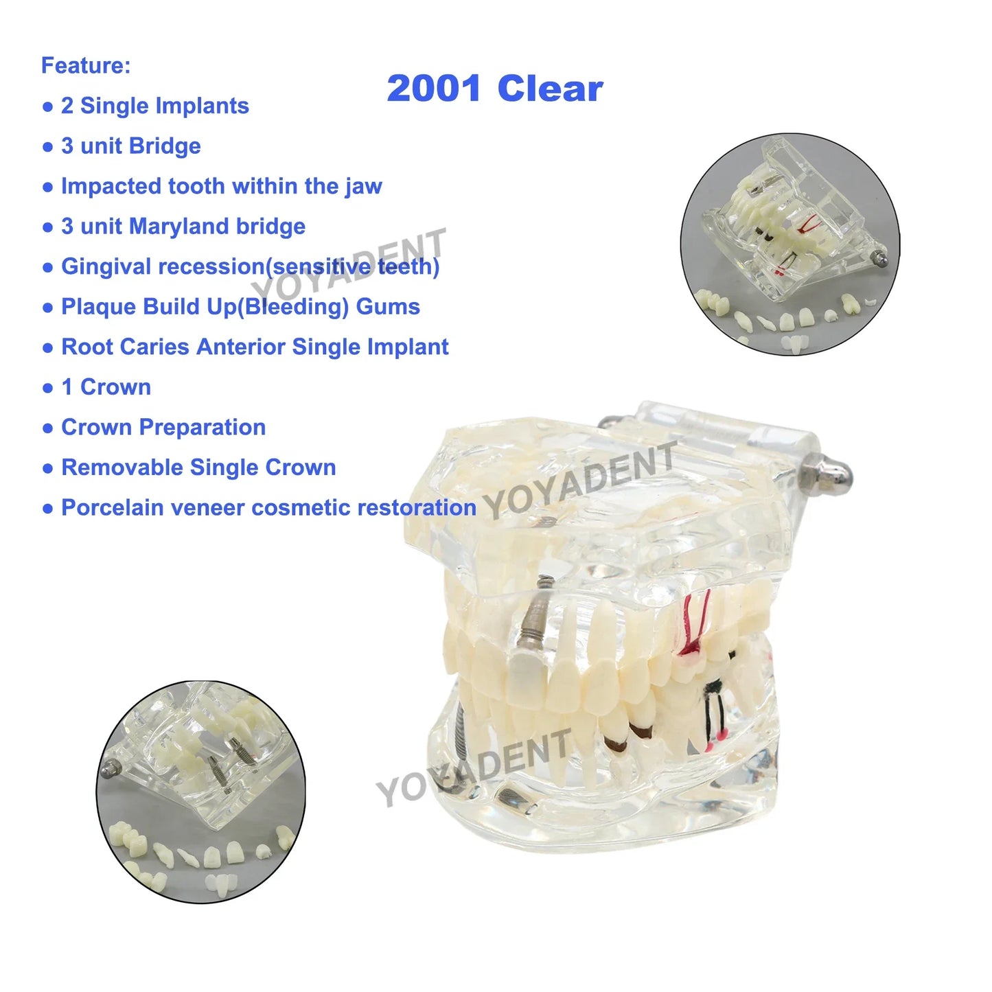 Dental Teeth Teaching Model Set – Typodont Orthodontic Practice Model for Dental Education, Study & Demonstration